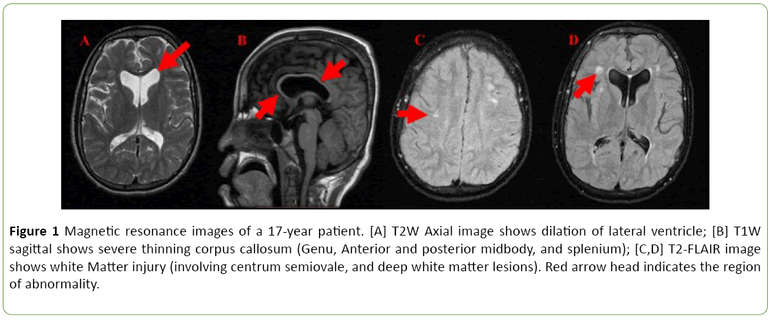 neuropsychiatry-lateral-ventricle